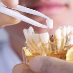 dental implant single
