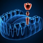 implant installation grap